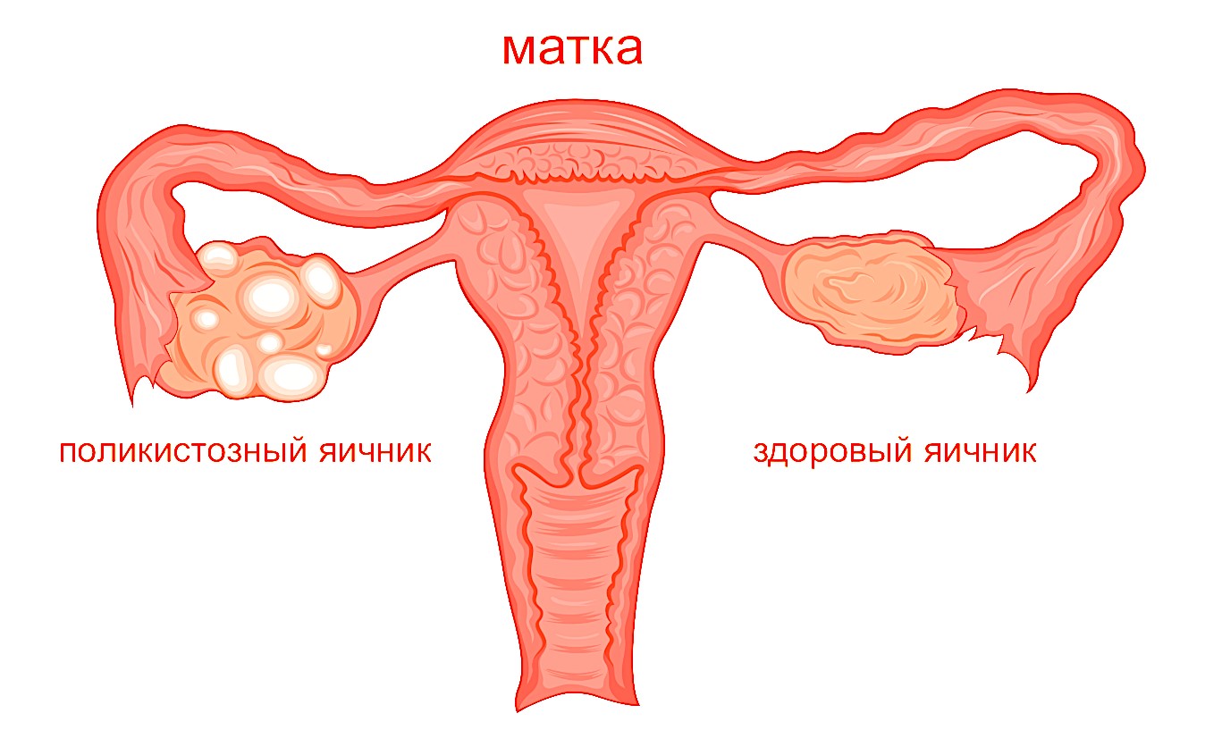 Рис. 2. Поликистозный яичник (схема)